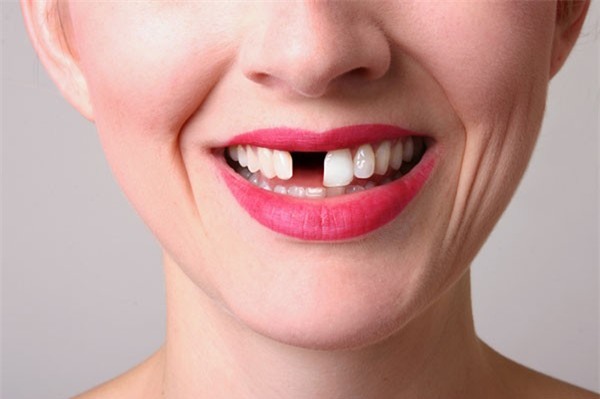 Giải mã giấc mơ: Rụng răng là điềm lành hay xấu mà nhiều người hay sợ?-2